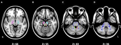 Altered Cerebellar White Matter in Sensory Processing Dysfunction Is Associated With Impaired Multisensory Integration and Attention